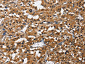 The image on the left is immunohistochemistry of paraffin-embedded Human thyroid cancer tissue using CSB-PA114100(IL2RB Antibody) at dilution 1/60, on the right is treated with fusion protein. (Original magnification: ×200)
