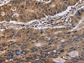 The image on the left is immunohistochemistry of paraffin-embedded Human colon cancer tissue using CSB-PA114148(EIF3H Antibody) at dilution 1/40, on the right is treated with fusion protein. (Original magnification: ×200)