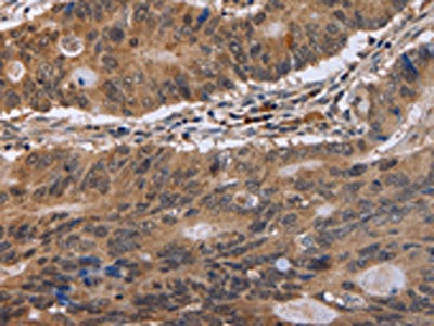 The image on the left is immunohistochemistry of paraffin-embedded Human colon cancer tissue using CSB-PA114148(EIF3H Antibody) at dilution 1/40, on the right is treated with fusion protein. (Original magnification: ×200)