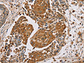 The image on the left is immunohistochemistry of paraffin-embedded Human lung cancer tissue using CSB-PA114224(MUC1 Antibody) at dilution 1/45, on the right is treated with synthetic peptide. (Original magnification: ×200)