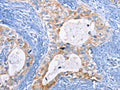 The image on the left is immunohistochemistry of paraffin-embedded Human cervical cancer tissue using CSB-PA114305(CFLAR Antibody) at dilution 1/15, on the right is treated with fusion protein. (Original magnification: ×200)