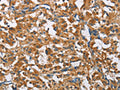 The image on the left is immunohistochemistry of paraffin-embedded Human thyroid cancer tissue using CSB-PA114413(COPB1 Antibody) at dilution 1/50, on the right is treated with fusion protein. (Original magnification: ×200)