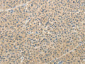The image on the left is immunohistochemistry of paraffin-embedded Human liver cancer tissue using CSB-PA114461(AFF2 Antibody) at dilution 1/25, on the right is treated with synthetic peptide. (Original magnification: ×200)