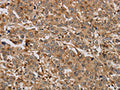 The image on the left is immunohistochemistry of paraffin-embedded Human liver cancer tissue using CSB-PA114463(ACHE Antibody) at dilution 1/20, on the right is treated with synthetic peptide. (Original magnification: X200)
