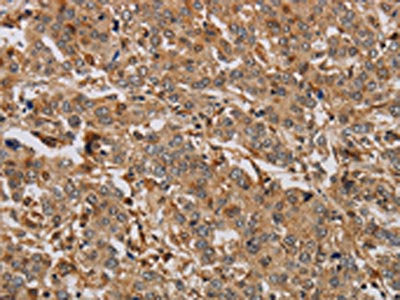 The image on the left is immunohistochemistry of paraffin-embedded Human liver cancer tissue using CSB-PA114463(ACHE Antibody) at dilution 1/20, on the right is treated with synthetic peptide. (Original magnification: X200)