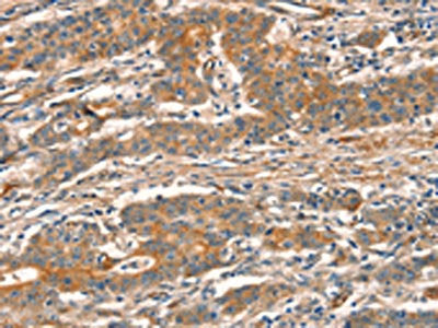 The image on the left is immunohistochemistry of paraffin-embedded Human gastic cancer tissue using CSB-PA114714(CUEDC2 Antibody) at dilution 1/30, on the right is treated with fusion protein. (Original magnification: ×200)