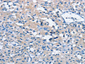 The image on the left is immunohistochemistry of paraffin-embedded Human thyroid cancer tissue using CSB-PA114726(BTN2A2 Antibody) at dilution 1/40, on the right is treated with fusion protein. (Original magnification: ×200)