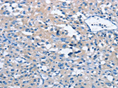 The image on the left is immunohistochemistry of paraffin-embedded Human thyroid cancer tissue using CSB-PA114726(BTN2A2 Antibody) at dilution 1/40, on the right is treated with fusion protein. (Original magnification: ×200)