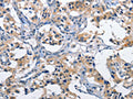 The image on the left is immunohistochemistry of paraffin-embedded Human thyroid cancer tissue using CSB-PA114834(CLEC2D Antibody) at dilution 1/60, on the right is treated with fusion protein. (Original magnification: ×200)
