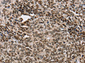 The image on the left is immunohistochemistry of paraffin-embedded Human ovarian cancer tissue using CSB-PA114928(ACVR1B Antibody) at dilution 1/25, on the right is treated with fusion protein. (Original magnification: ×200)