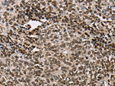 The image on the left is immunohistochemistry of paraffin-embedded Human ovarian cancer tissue using CSB-PA114928(ACVR1B Antibody) at dilution 1/25, on the right is treated with fusion protein. (Original magnification: ×200)