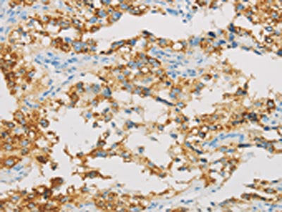 The image on the left is immunohistochemistry of paraffin-embedded Human thyroid cancer tissue using CSB-PA114986(IDH3B Antibody) at dilution 1/30, on the right is treated with fusion protein. (Original magnification: ×200)