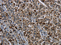 The image on the left is immunohistochemistry of paraffin-embedded Human liver cancer tissue using CSB-PA115108(GP1BA Antibody) at dilution 1/50, on the right is treated with fusion protein. (Original magnification: ×200)