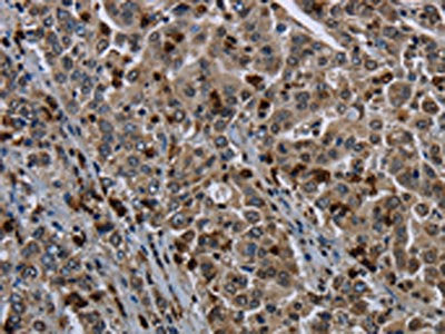 The image on the left is immunohistochemistry of paraffin-embedded Human liver cancer tissue using CSB-PA115108(GP1BA Antibody) at dilution 1/50, on the right is treated with fusion protein. (Original magnification: ×200)
