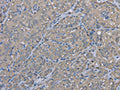The image on the left is immunohistochemistry of paraffin-embedded Human thyroid cancer tissue using CSB-PA115608(EZR Antibody) at dilution 1/30, on the right is treated with fusion protein. (Original magnification: ×200)
