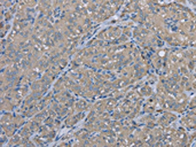 The image on the left is immunohistochemistry of paraffin-embedded Human thyroid cancer tissue using CSB-PA115608(EZR Antibody) at dilution 1/30, on the right is treated with fusion protein. (Original magnification: ×200)