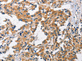 The image on the left is immunohistochemistry of paraffin-embedded Human thyroid cancer tissue using CSB-PA116460(CHMP1A Antibody) at dilution 1/60, on the right is treated with fusion protein. (Original magnification: ×200)