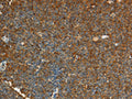 The image on the left is immunohistochemistry of paraffin-embedded Human lymphoma tissue using CSB-PA116506(ADM Antibody) at dilution 1/20, on the right is treated with synthetic peptide. (Original magnification: ×200)