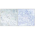 Immunohistochemistry analysis of paraffin-embedded human breast carcinoma tissue, using TP53INP2 antibody.