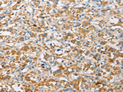 The image on the left is immunohistochemistry of paraffin-embedded Human thyroid cancer tissue using CSB-PA117483(APOBEC3G Antibody) at dilution 1/30, on the right is treated with fusion protein. (Original magnification: ×200)