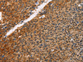 The image on the left is immunohistochemistry of paraffin-embedded Human liver cancer tissue using CSB-PA117532(PRKAA2 Antibody) at dilution 1/25, on the right is treated with fusion protein. (Original magnification: ×200)