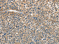 The image on the left is immunohistochemistry of paraffin-embedded Human liver cancer tissue using CSB-PA117703(ANGPT1 Antibody) at dilution 1/30, on the right is treated with fusion protein. (Original magnification: ×200)