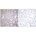 Immunohistochemical analysis of paraffin-embedded human breast carcinoma tissue using Claudin 2 antibody.