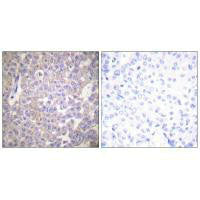Immunohistochemical analysis of paraffin-embedded human breast carcinoma tissue using Claudin 2 antibody.
