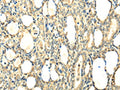 The image on the left is immunohistochemistry of paraffin-embedded Human thyroid cancer tissue using CSB-PA118672(CCL25 Antibody) at dilution 1/20, on the right is treated with fusion protein. (Original magnification: ×200)