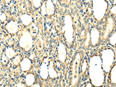 The image on the left is immunohistochemistry of paraffin-embedded Human thyroid cancer tissue using CSB-PA118672(CCL25 Antibody) at dilution 1/20, on the right is treated with fusion protein. (Original magnification: ×200)