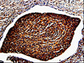 The image is immunohistochemistry of paraffin-embedded Human cervical cancer tissue using CSB-PA118689(ANXA7 Antibody) at dilution 1/150. (Original magnification: ×200)