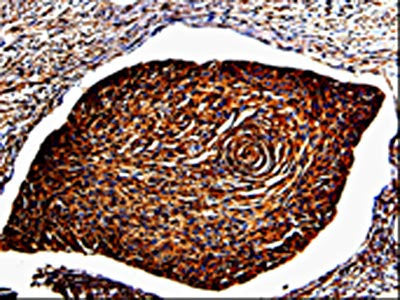 The image is immunohistochemistry of paraffin-embedded Human cervical cancer tissue using CSB-PA118689(ANXA7 Antibody) at dilution 1/150. (Original magnification: ×200)