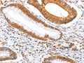 The image on the left is immunohistochemistry of paraffin-embedded Human colon cancer tissue using CSB-PA118910(DPPA2 Antibody) at dilution 1/25, on the right is treated with fusion protein. (Original magnification: ×200)