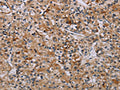 The image on the left is immunohistochemistry of paraffin-embedded Human prostate cancer tissue using CSB-PA119051(AATK Antibody) at dilution 1/45, on the right is treated with synthetic peptide. (Original magnification: ×200)