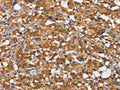 The image on the left is immunohistochemistry of paraffin-embedded Human thyroid cancer tissue using CSB-PA119240(ARMCX2 Antibody) at dilution 1/30, on the right is treated with fusion protein. (Original magnification: ×200)