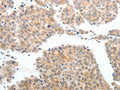 The image on the left is immunohistochemistry of paraffin-embedded Human liver cancer tissue using CSB-PA119696(ABL2 Antibody) at dilution 1/25, on the right is treated with synthetic peptide. (Original magnification: ×200)