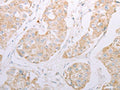 The image on the left is immunohistochemistry of paraffin-embedded Human breast cancer tissue using CSB-PA119733(ADAM28 Antibody) at dilution 1/30, on the right is treated with synthetic peptide. (Original magnification: ×200)