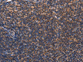 The image on the left is immunohistochemistry of paraffin-embedded Human tonsil tissue using CSB-PA120056(RDX Antibody) at dilution 1/60, on the right is treated with fusion protein. (Original magnification: ×200)