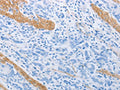 The image on the left is immunohistochemistry of paraffin-embedded Human gastic cancer tissue using CSB-PA120361(ADRB3 Antibody) at dilution 1/20, on the right is treated with synthetic peptide. (Original magnification: ×200)
