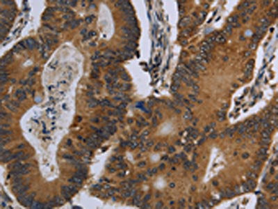 The image on the left is immunohistochemistry of paraffin-embedded Human colon cancer tissue using CSB-PA120525(FGF18 Antibody) at dilution 1/20, on the right is treated with fusion protein. (Original magnification: ×200)