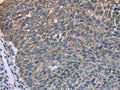 The image on the left is immunohistochemistry of paraffin-embedded Human lung cancer tissue using CSB-PA120564(GNAI3 Antibody) at dilution 1/30, on the right is treated with fusion protein. (Original magnification: ×200)