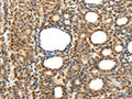 The image on the left is immunohistochemistry of paraffin-embedded Human thyroid cancer tissue using CSB-PA120806(SYT7 Antibody) at dilution 1/15, on the right is treated with fusion protein. (Original magnification: ×200)