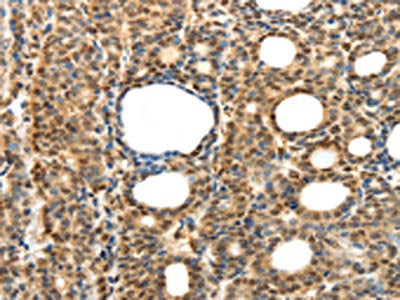 The image on the left is immunohistochemistry of paraffin-embedded Human thyroid cancer tissue using CSB-PA120806(SYT7 Antibody) at dilution 1/15, on the right is treated with fusion protein. (Original magnification: ×200)
