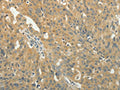 The image on the left is immunohistochemistry of paraffin-embedded Human ovarian cancer tissue using CSB-PA121037(TAGLN2 Antibody) at dilution 1/40, on the right is treated with fusion protein. (Original magnification: ×200)