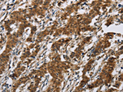 The image on the left is immunohistochemistry of paraffin-embedded Human gastic cancer tissue using CSB-PA121041(IL17RB Antibody) at dilution 1/40, on the right is treated with synthetic peptide. (Original magnification: ×200)