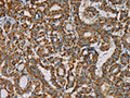 The image on the left is immunohistochemistry of paraffin-embedded Human thyroid cancer tissue using CSB-PA121059(IPO13 Antibody) at dilution 1/25, on the right is treated with fusion protein. (Original magnification: ×200)