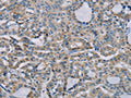 The image on the left is immunohistochemistry of paraffin-embedded Human thyroid cancer tissue using CSB-PA121181(NDUFS7 Antibody) at dilution 1/20, on the right is treated with fusion protein. (Original magnification: ×200)