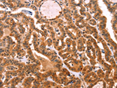 The image on the left is immunohistochemistry of paraffin-embedded Human thyroid cancer tissue using CSB-PA121719(PROS1 Antibody) at dilution 1/40, on the right is treated with fusion protein. (Original magnification: ×200)