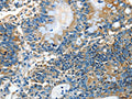 The image on the left is immunohistochemistry of paraffin-embedded Human colon cancer tissue using CSB-PA122487(ADCK4 Antibody) at dilution 1/25, on the right is treated with fusion protein. (Original magnification: ×200)