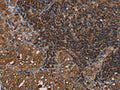 The image on the left is immunohistochemistry of paraffin-embedded Human thyroid cancer tissue using CSB-PA123223(HOMER2 Antibody) at dilution 1/40, on the right is treated with fusion protein. (Original magnification: ×200)